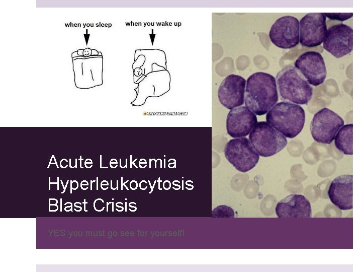 Acute Leukemia Hyperleukocytosis Blast Crisis YES you must go see for yourself! 
