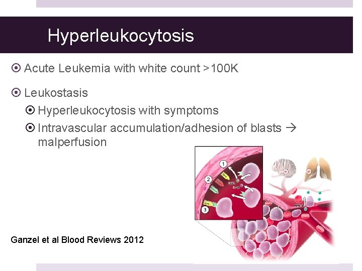 Hyperleukocytosis Acute Leukemia with white count >100 K Leukostasis Hyperleukocytosis with symptoms Intravascular accumulation/adhesion