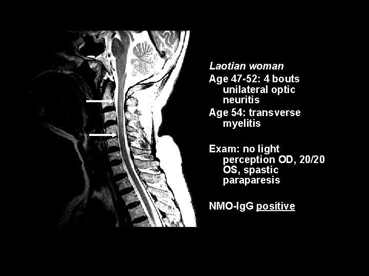 Laotian woman Age 47 -52: 4 bouts unilateral optic neuritis Age 54: transverse myelitis