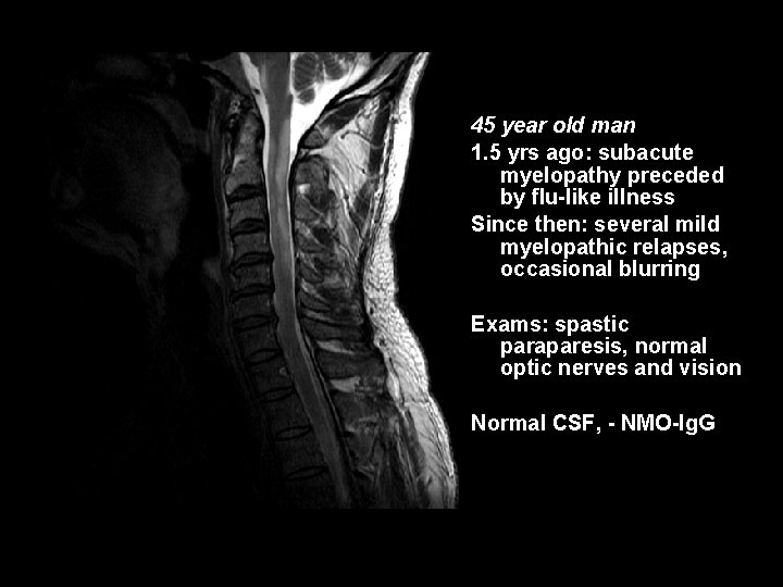 45 year old man 1. 5 yrs ago: subacute myelopathy preceded by flu-like illness