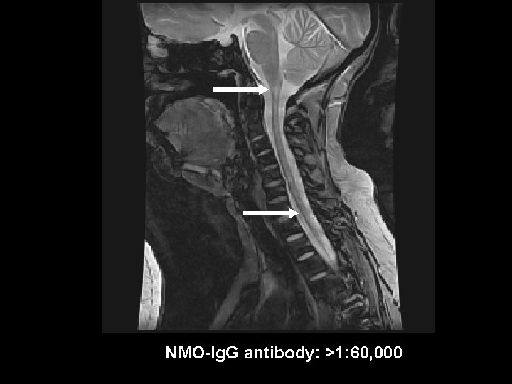 NMO-Ig. G antibody: >1: 60, 000 