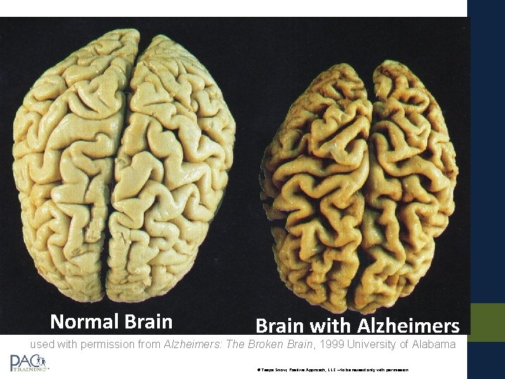 Normal Brain with Alzheimers used with permission from Alzheimers: The Broken Brain, 1999 University Normal Brain with Alzheimers used with permission from Alzheimers: The Broken Brain, 1999 University