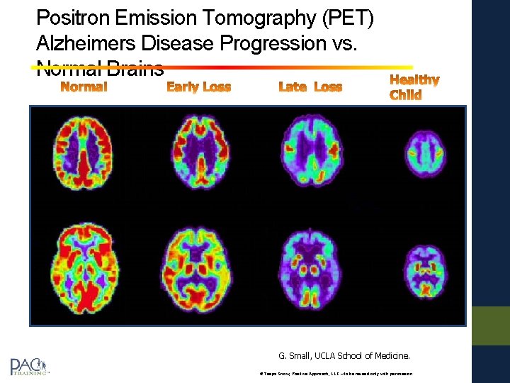 Positron Emission Tomography (PET) Alzheimers Disease Progression vs. Normal Brains G. Small, UCLA School