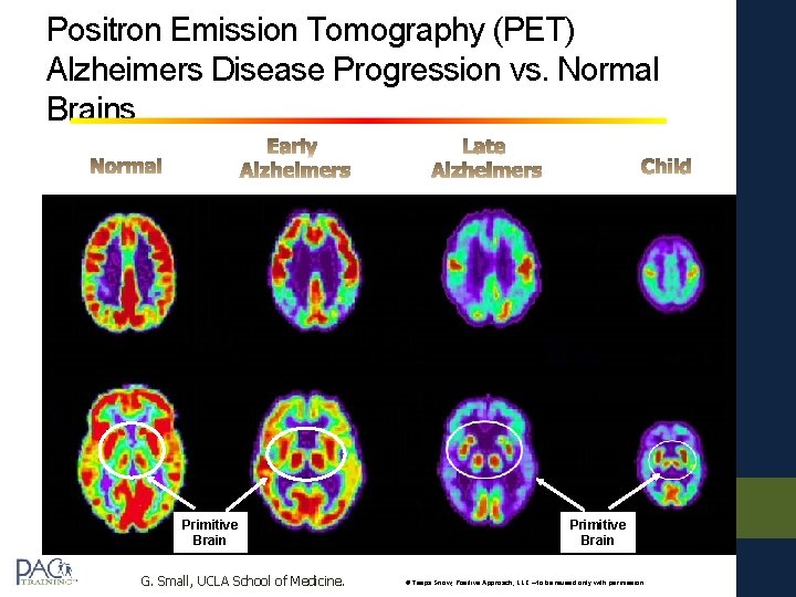 Positron Emission Tomography (PET) Alzheimers Disease Progression vs. Normal Brains Primitive Brain G. Small,