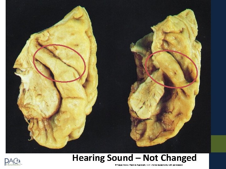 Hearing Sound – Not Changed © Teepa Snow, Positive Approach, LLC – to be Hearing Sound – Not Changed © Teepa Snow, Positive Approach, LLC – to be