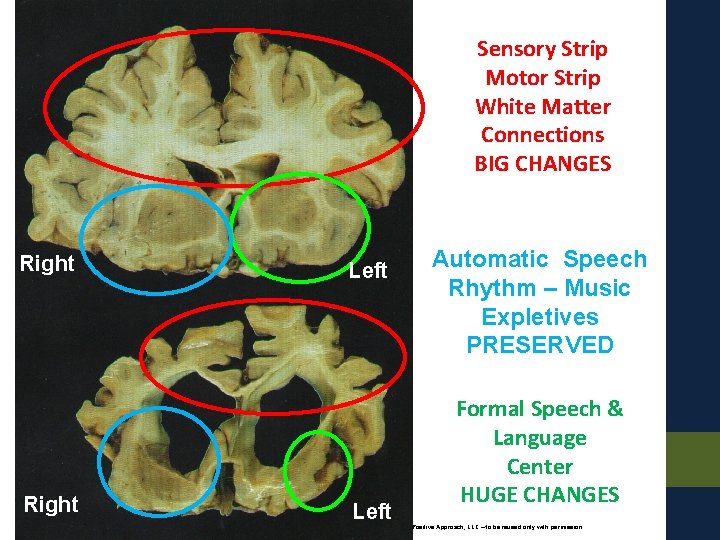 Sensory Strip Motor Strip White Matter Connections BIG CHANGES Right Left Automatic Speech Rhythm