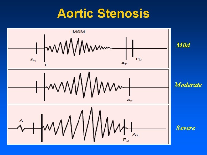 Aortic Stenosis Mild Moderate Severe 