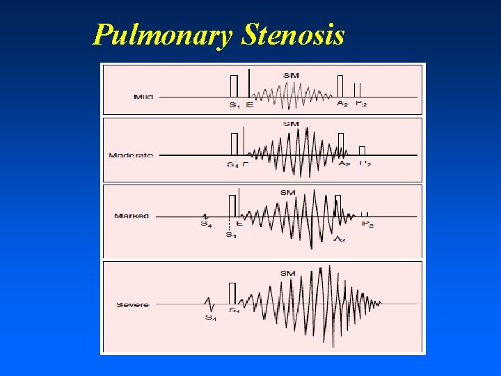 Pulmonary Stenosis 