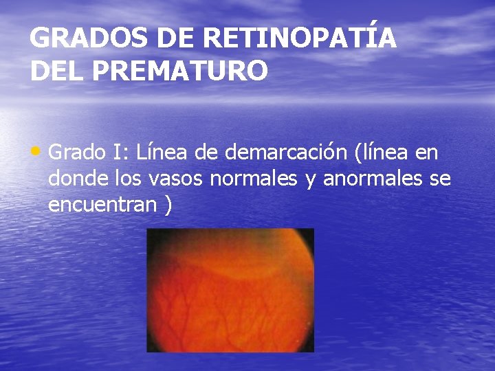 GRADOS DE RETINOPATÍA DEL PREMATURO • Grado I: Línea de demarcación (línea en donde