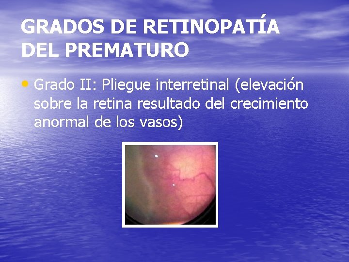 GRADOS DE RETINOPATÍA DEL PREMATURO • Grado II: Pliegue interretinal (elevación sobre la retina