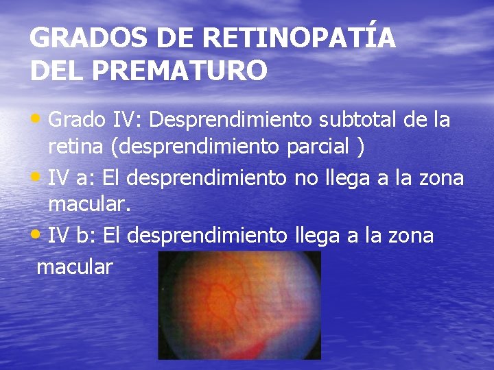 GRADOS DE RETINOPATÍA DEL PREMATURO • Grado IV: Desprendimiento subtotal de la retina (desprendimiento