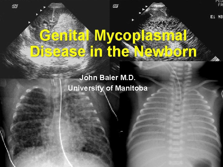 Genital Mycoplasmal Disease in the Newborn John Baier M. D. University of Manitoba 