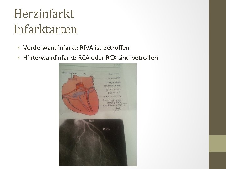 Herzinfarkt Infarktarten • Vorderwandinfarkt: RIVA ist betroffen • Hinterwandinfarkt: RCA oder RCX sind betroffen