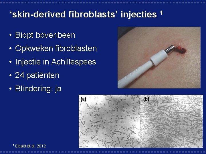 ‘skin-derived fibroblasts’ injecties 1 • Biopt bovenbeen • Opkweken fibroblasten • Injectie in Achillespees