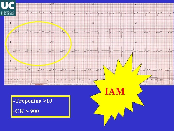 IAM -Troponina >10 -CK > 900 