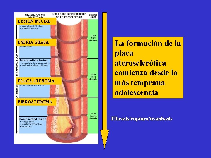 LESION INICIAL ESTRÍA GRASA PLACA ATEROMA Acumulación de LDL La formación oxidadas de la