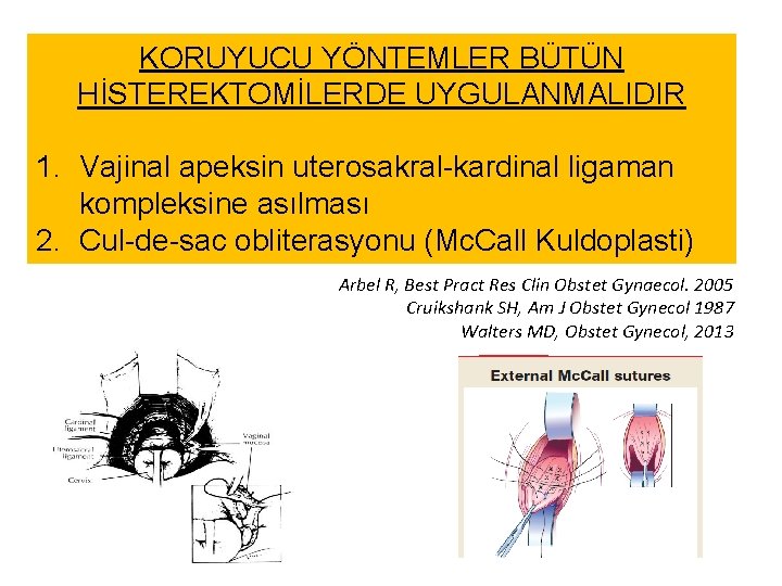 KORUYUCU YÖNTEMLER BÜTÜN HİSTEREKTOMİLERDE UYGULANMALIDIR 1. Vajinal apeksin uterosakral-kardinal ligaman kompleksine asılması 2. Cul-de-sac KORUYUCU YÖNTEMLER BÜTÜN HİSTEREKTOMİLERDE UYGULANMALIDIR 1. Vajinal apeksin uterosakral-kardinal ligaman kompleksine asılması 2. Cul-de-sac