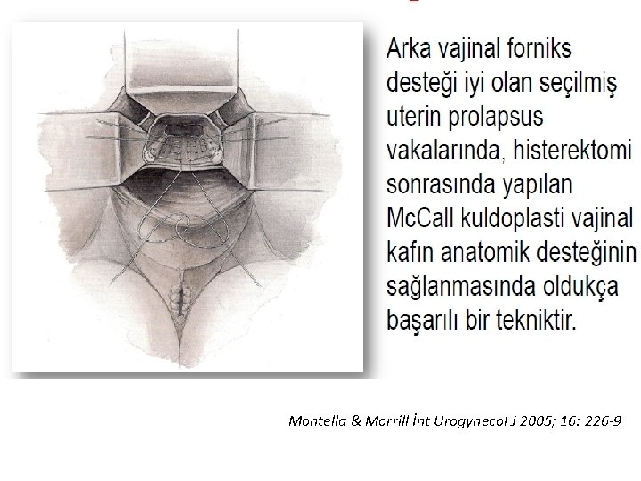 Montella & Morrill İnt Urogynecol J 2005; 16: 226 -9 Montella & Morrill İnt Urogynecol J 2005; 16: 226 -9