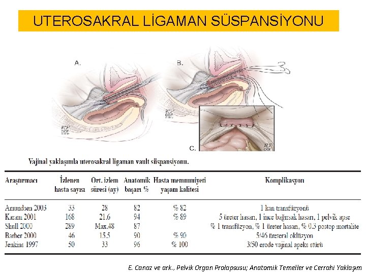 UTEROSAKRAL LİGAMAN SÜSPANSİYONU E. Canaz ve ark. , Pelvik Organ Prolapsusu; Anatomik Temeller ve UTEROSAKRAL LİGAMAN SÜSPANSİYONU E. Canaz ve ark. , Pelvik Organ Prolapsusu; Anatomik Temeller ve