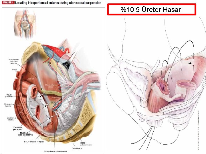 %10, 9 Üreter Hasarı %10, 9 Üreter Hasarı