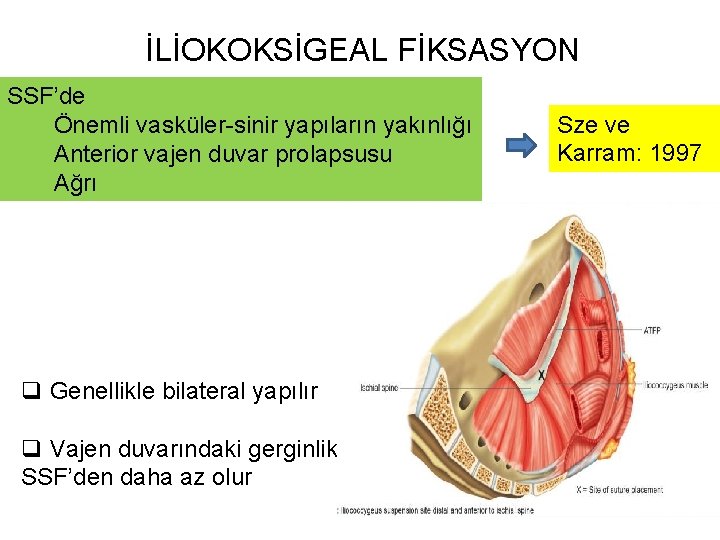 İLİOKOKSİGEAL FİKSASYON SSF’de Önemli vasküler-sinir yapıların yakınlığı Anterior vajen duvar prolapsusu Ağrı q Genellikle İLİOKOKSİGEAL FİKSASYON SSF’de Önemli vasküler-sinir yapıların yakınlığı Anterior vajen duvar prolapsusu Ağrı q Genellikle