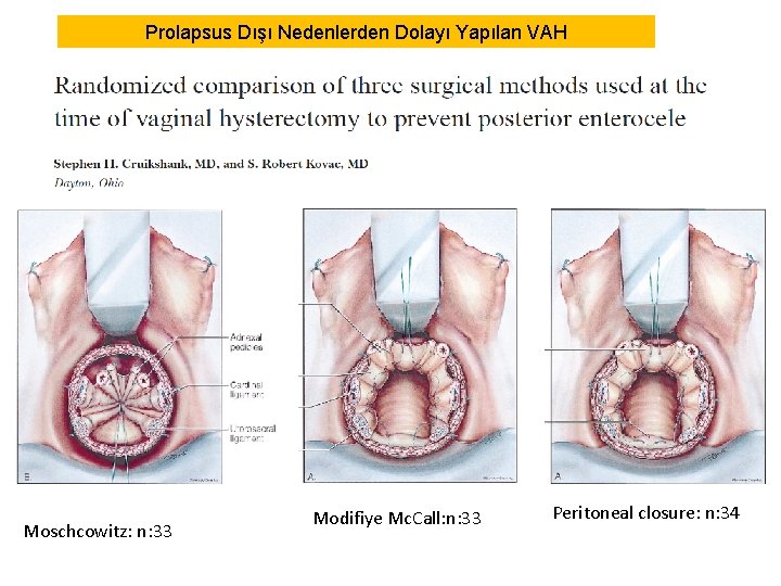 Prolapsus Dışı Nedenlerden Dolayı Yapılan VAH Moschcowitz: n: 33 Modifiye Mc. Call: n: 33 Prolapsus Dışı Nedenlerden Dolayı Yapılan VAH Moschcowitz: n: 33 Modifiye Mc. Call: n: 33
