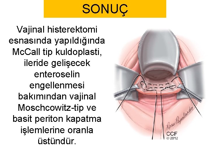 SONUÇ Vajinal histerektomi esnasında yapıldığında Mc. Call tip kuldoplasti, ileride gelişecek enteroselin engellenmesi bakımından SONUÇ Vajinal histerektomi esnasında yapıldığında Mc. Call tip kuldoplasti, ileride gelişecek enteroselin engellenmesi bakımından