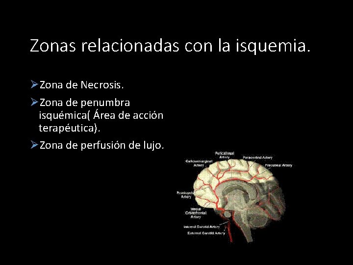 Zonas relacionadas con la isquemia. ØZona de Necrosis. ØZona de penumbra isquémica( Área de