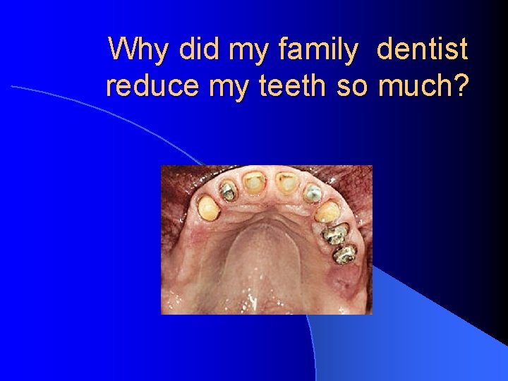 Why did my family dentist reduce my teeth so much? 