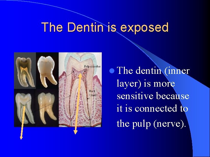 The Dentin is exposed l The dentin (inner layer) is more sensitive because it