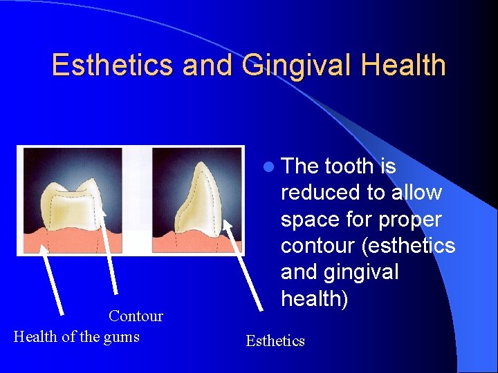 Esthetics and Gingival Health l The Contour Health of the gums tooth is reduced