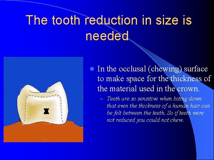 The tooth reduction in size is needed l In the occlusal (chewing) surface to