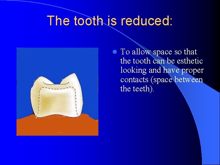 The tooth is reduced: l To allow space so that the tooth can be