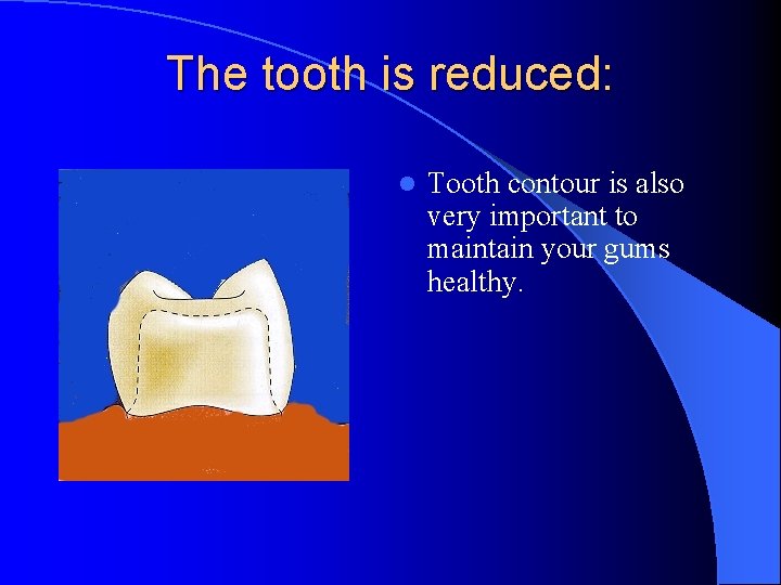 The tooth is reduced: l Tooth contour is also very important to maintain your