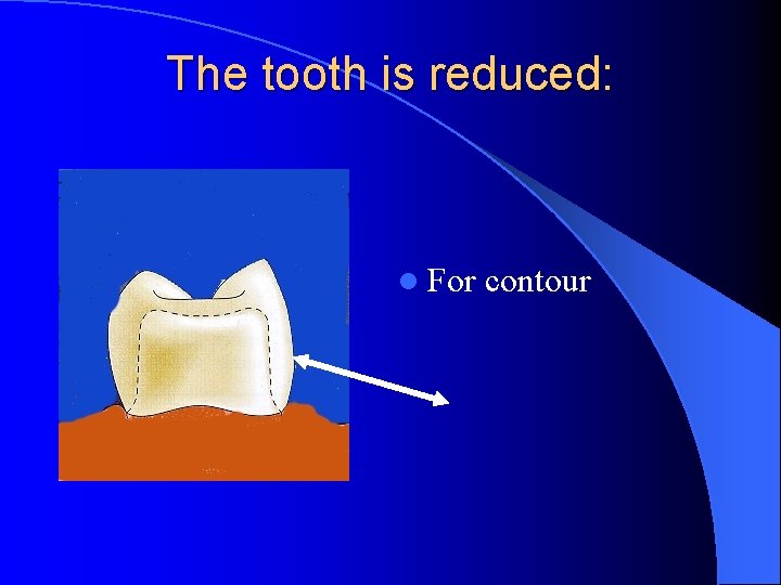 The tooth is reduced: l For contour 