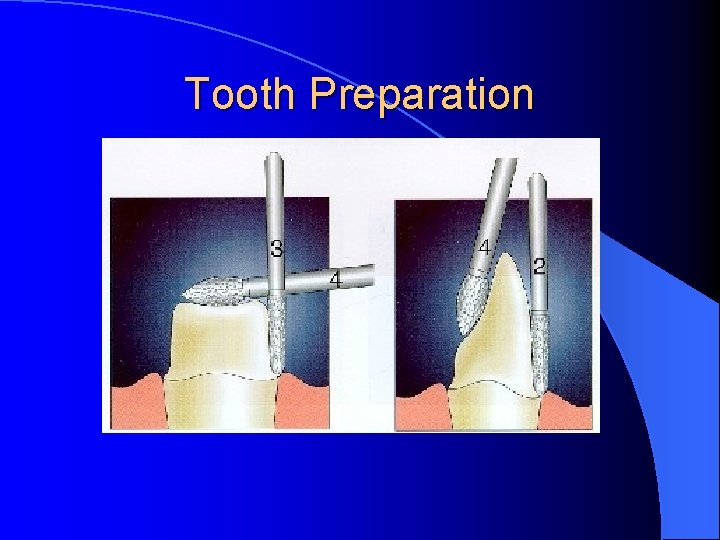 Tooth Preparation 