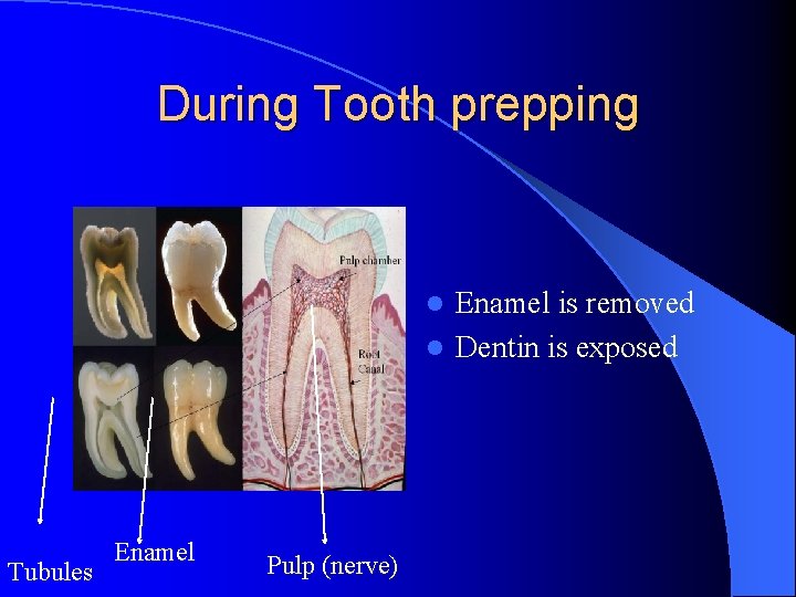 During Tooth prepping Enamel is removed l Dentin is exposed l Tubules Enamel Pulp