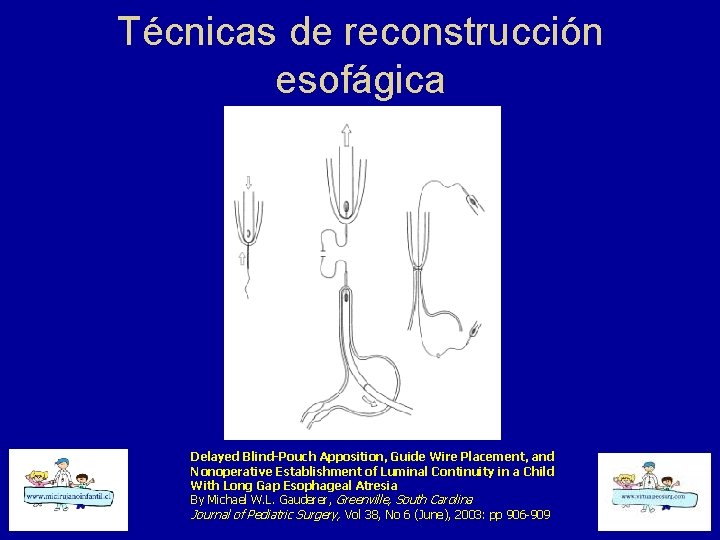 Técnicas de reconstrucción esofágica Delayed Blind-Pouch Apposition, Guide Wire Placement, and Nonoperative Establishment of