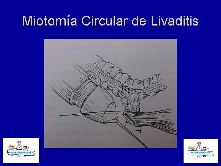 Miotomía Circular de Livaditis 