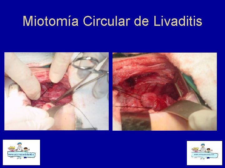 Miotomía Circular de Livaditis 