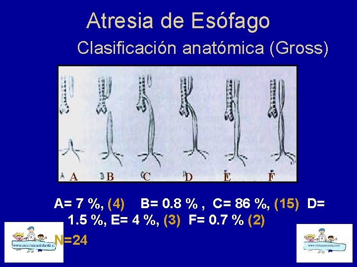 Atresia de Esófago Clasificación anatómica (Gross) A B C D E F A= 7