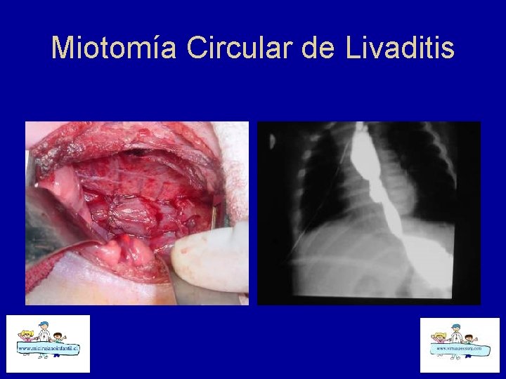 Miotomía Circular de Livaditis 