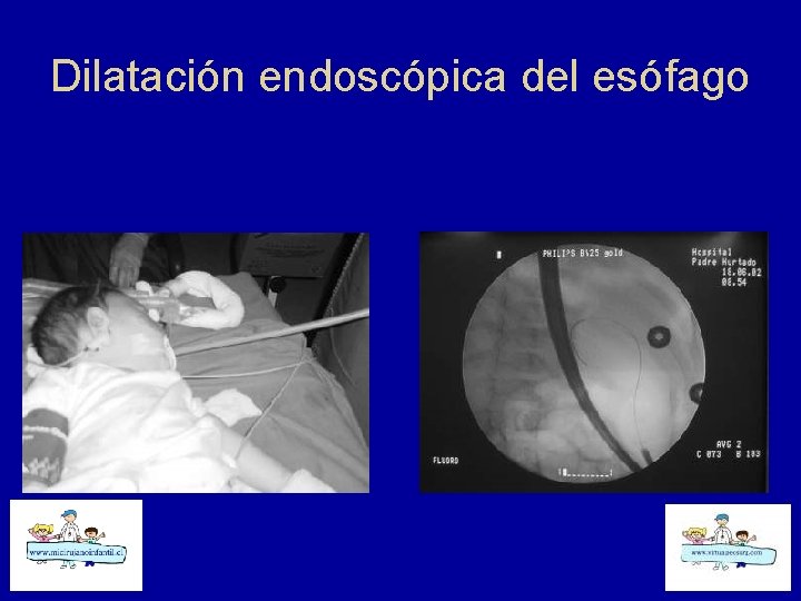 Dilatación endoscópica del esófago 