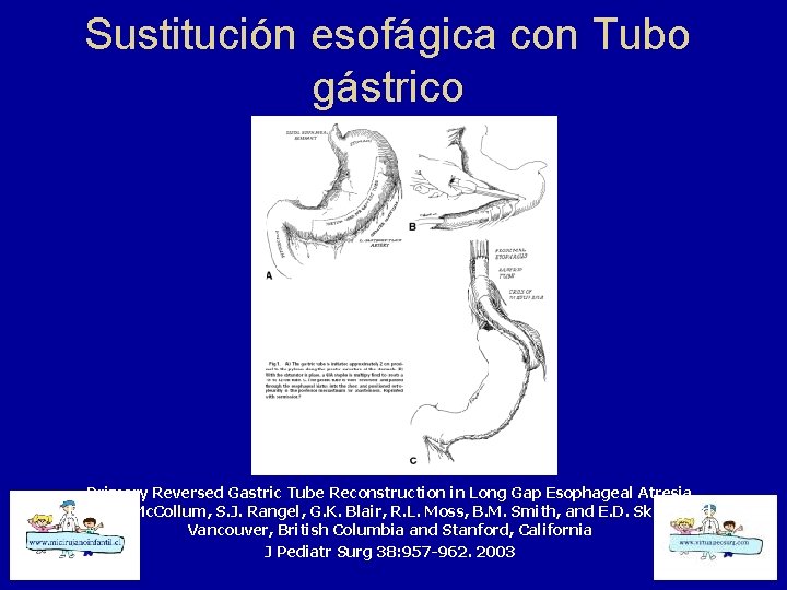 Sustitución esofágica con Tubo gástrico Primary Reversed Gastric Tube Reconstruction in Long Gap Esophageal