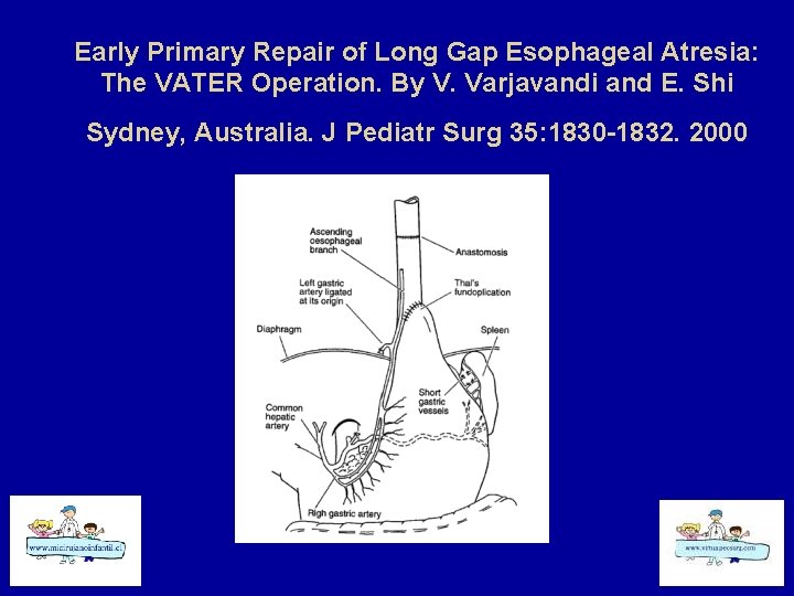 Early Primary Repair of Long Gap Esophageal Atresia: The VATER Operation. By V. Varjavandi