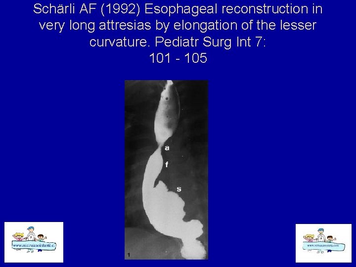 Schärli AF (1992) Esophageal reconstruction in very long attresias by elongation of the lesser