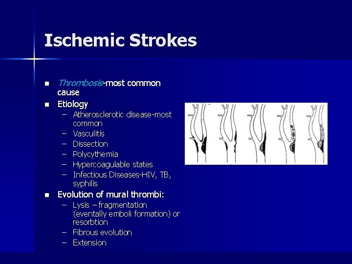 Ischemic Strokes n n Thrombosis-most common cause Etiology – Atherosclerotic disease-most common – Vasculitis