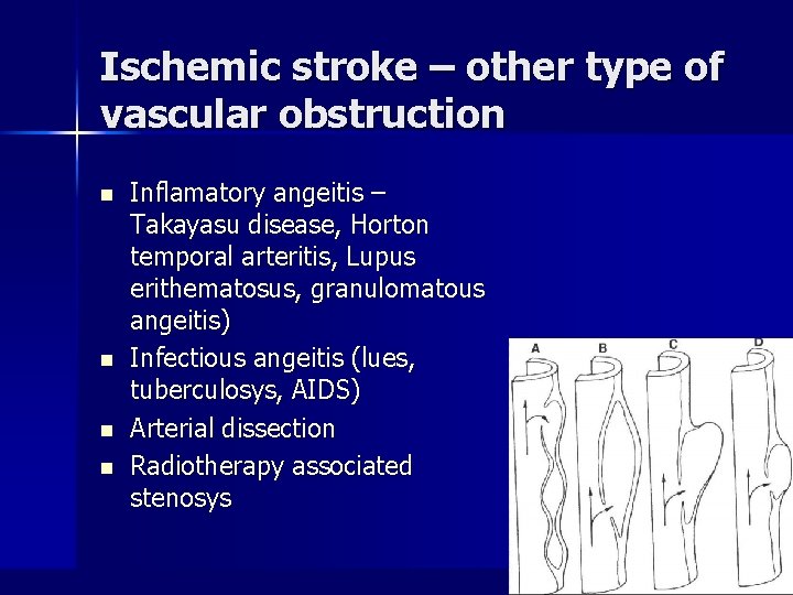 Ischemic stroke – other type of vascular obstruction n n Inflamatory angeitis – Takayasu