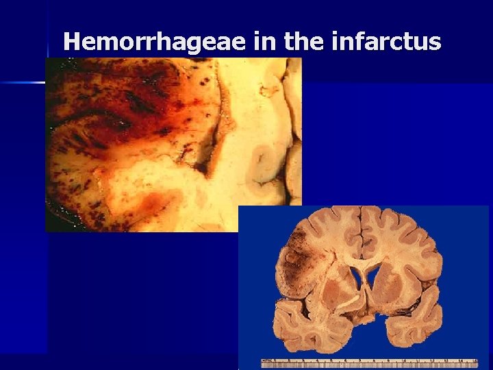 Hemorrhageae in the infarctus area 