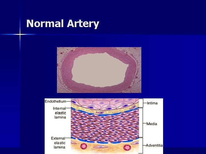 Normal Artery 